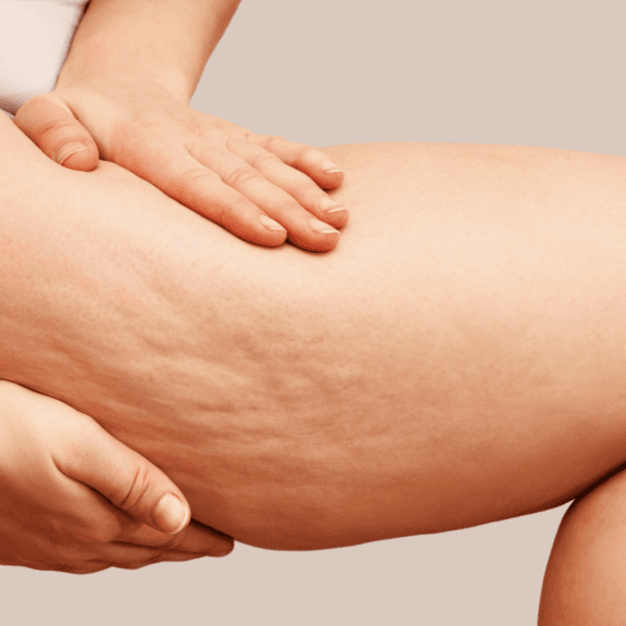6 sessions celluite treatment at All Elements Lounge in Anaheim, CA